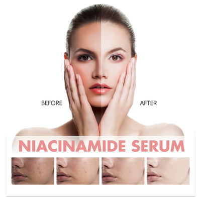 Peach Niacinamide Facial Serum Fade Melanin Dark Spot Shrink Pores Smooth Brighten Skin Moisturizing Rejuvenation Skincare