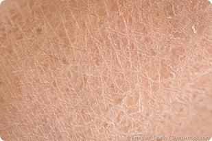 Dry Skin